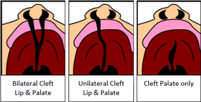 cleft palate repair post op